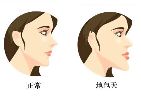 什么是地包天？地包天長(zhǎng)什么樣子？地包天牙齒圖片