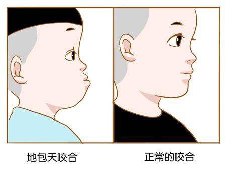 什么是地包天？地包天長(zhǎng)什么樣子？地包天牙齒圖片